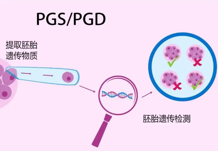 美国三代试管婴儿pgd技术可以筛查哪些疾病