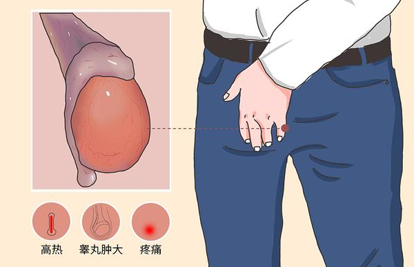 梗阻性无精症