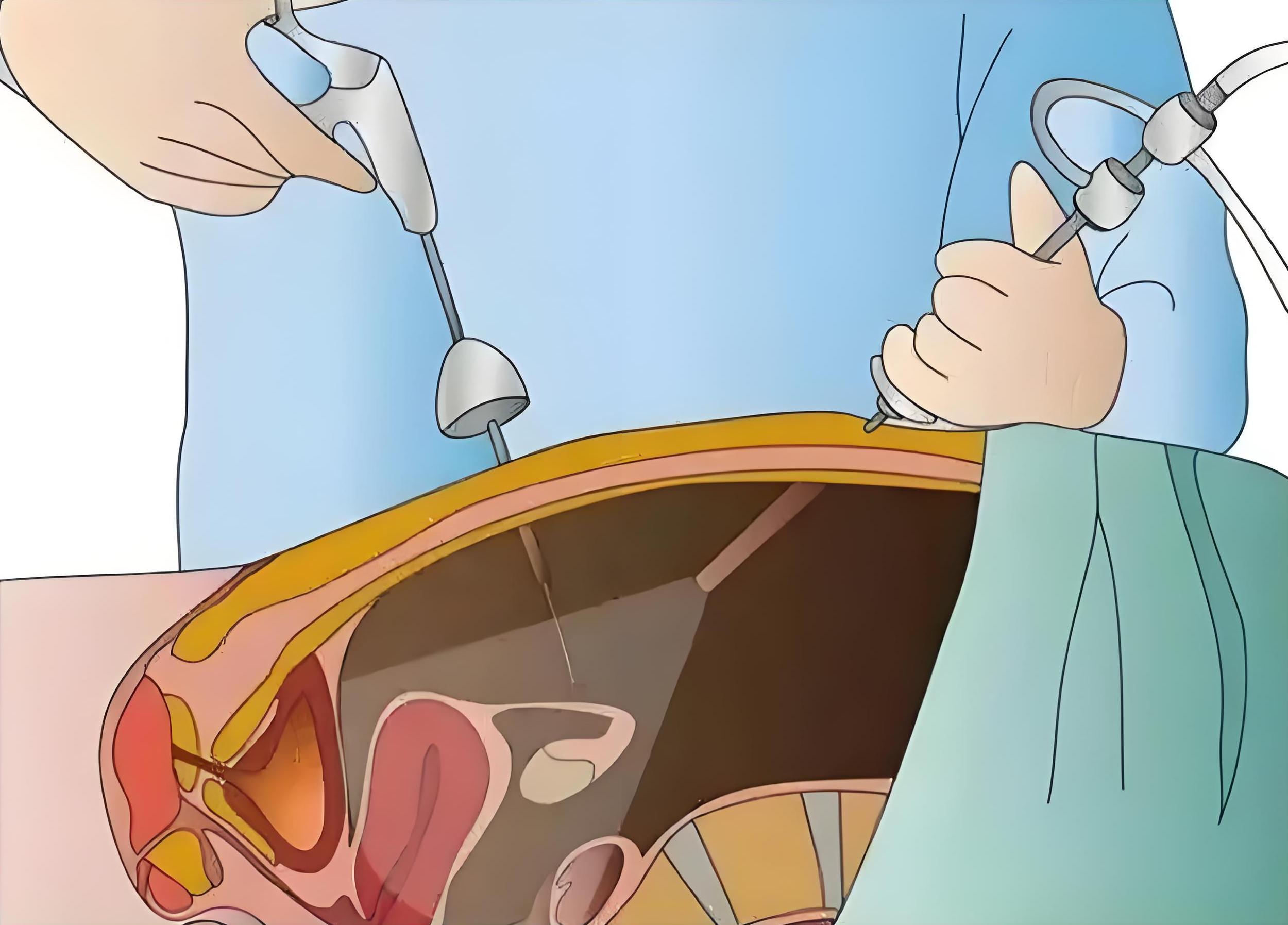 腹腔镜检查