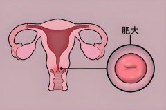 宫颈肥大是什么因素导致的，影响赴美做试管吗？