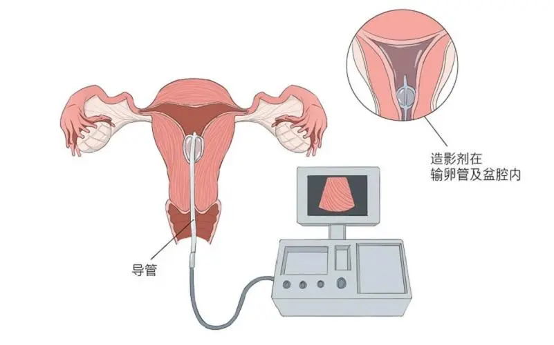 输卵管造影