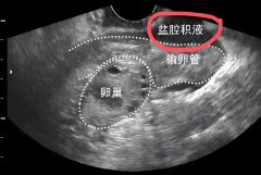 内膜液性分离影响美国试管婴儿移植吗？