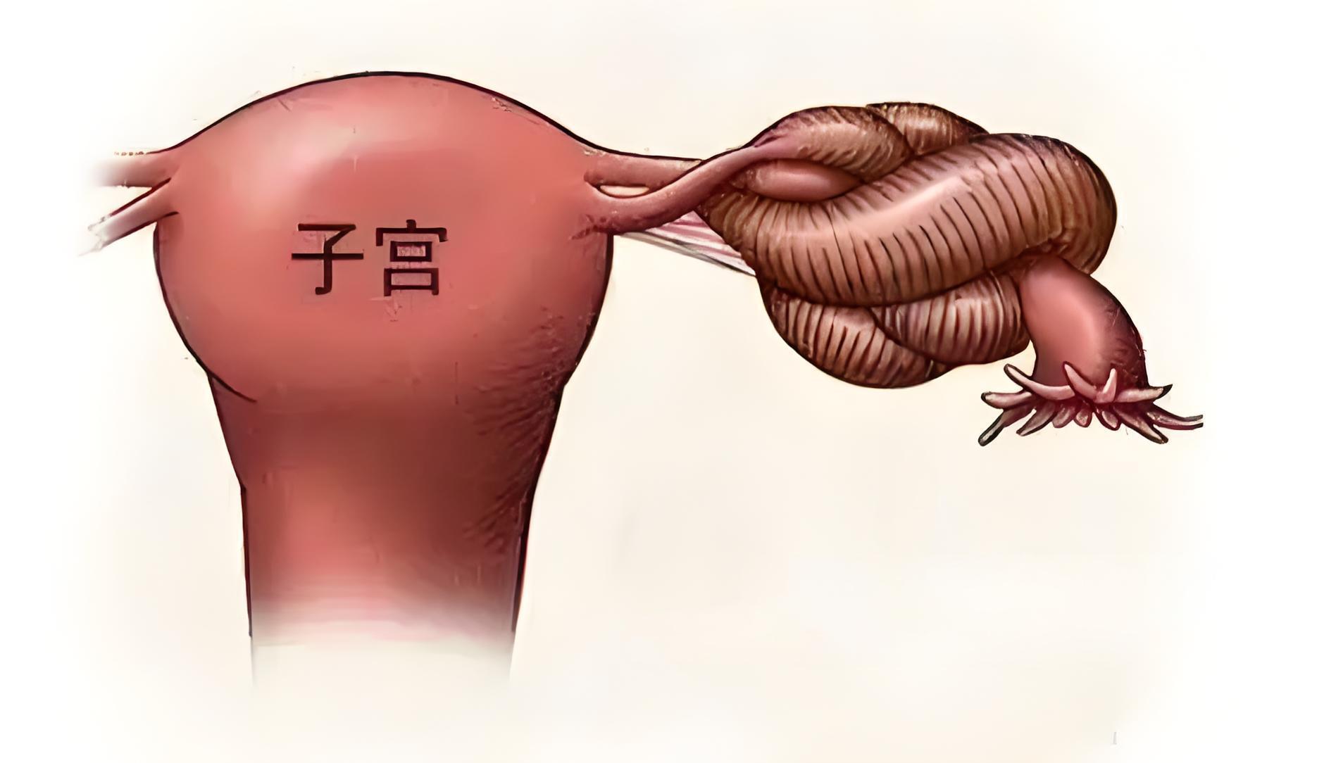 输卵管扭曲