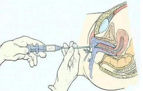 宫腔灌注