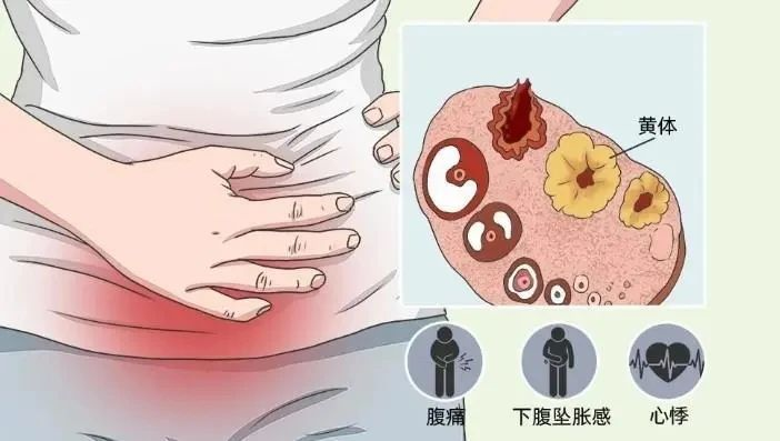 黄体破裂