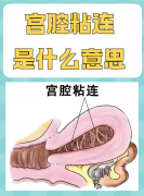 试管婴儿宫腔粘连——如何修复胚胎着床的土壤？